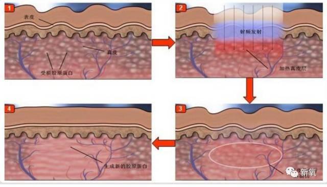 120斤的刘涛为减肥直播喝不明红色液体?而90斤的张雪迎脚踝比脖子粗...