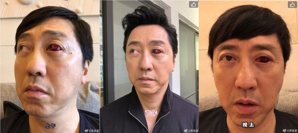 庾澄庆眼球布满血块:血管老化 已三度复发
